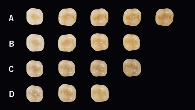 Éléments de prothèse A1-D4 remplis en occlusion avec Venus Bulk Flow ONE.